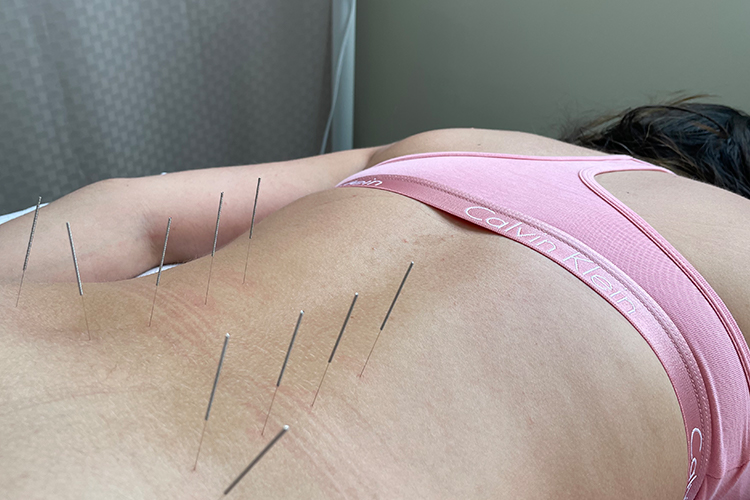 A woman getting acupuncture which is considered alternative medicine